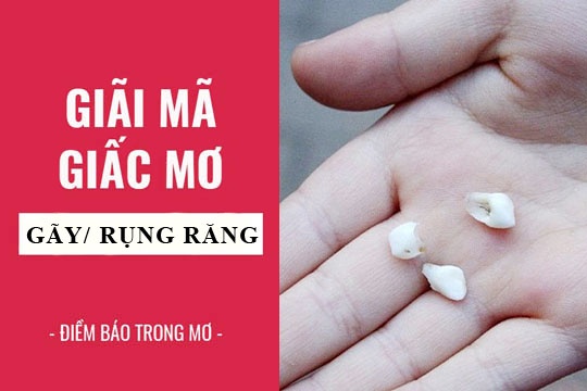 Mơ thấy gãy răng ẩn chứa ý nghĩa gì? Tốt hay xấu?