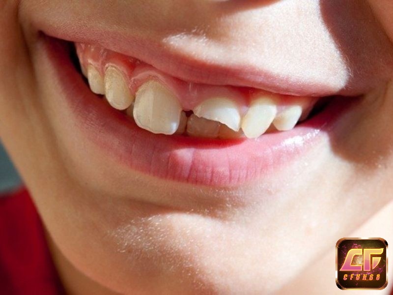 Mộng thấy răng bị vỡ cảnh báo về việc tiêu tiền không kiểm soát